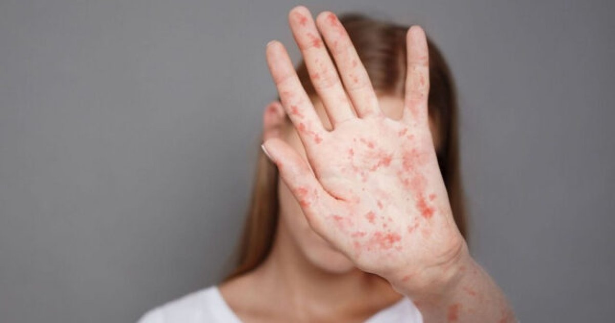 Banqladeşdə 6400 uşaq qızılcaya yoluxub, ölənlər var