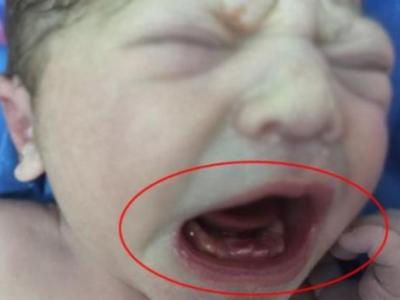 Türkiyədə dişləri olan uşaq doğulub