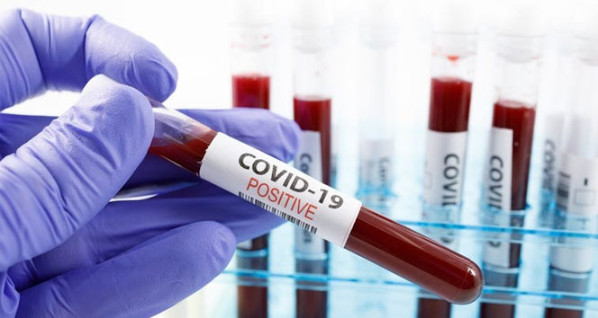Azərbaycanda koronavirusa 529 yeni yoluxma qeydə alınıb, ölənlər var
