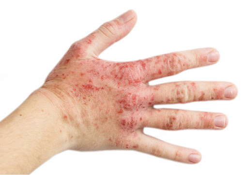 70-dən çox məhsul qida allergiyasına səbəb ola bilər